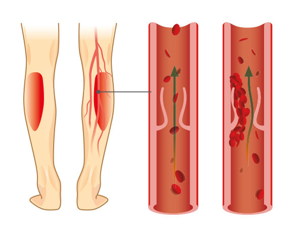 Querschnittsdarstellung einer Vene mit und ohne Thrombus