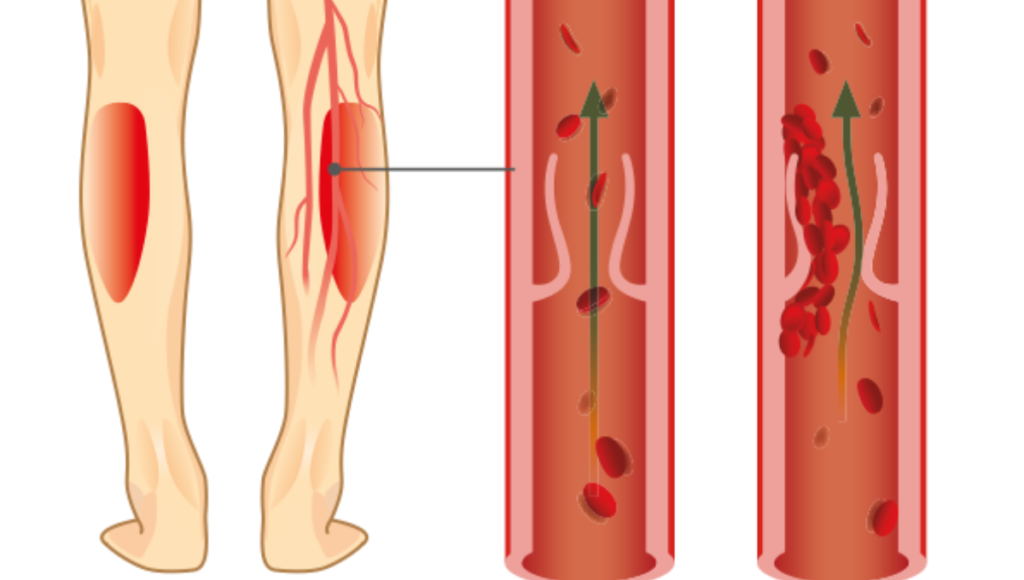 Querschnittsdarstellung einer Vene mit und ohne Thrombus