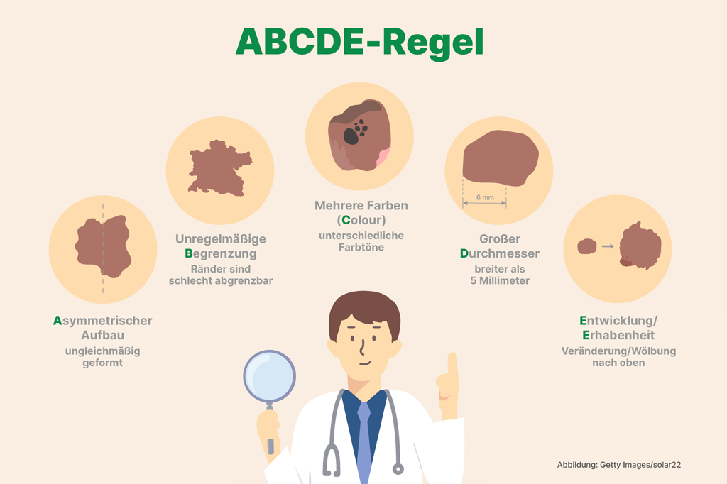 Darstellung und Visualisierung der ABCDE-Regel zur Erkennung von schwarzem Hautkrebs