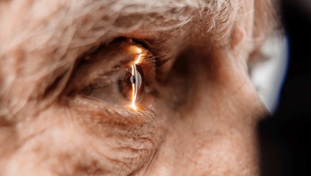 Eine Nahaufnahme eines Auge, das eine altersbedingte Makuladegeneration aufweist.