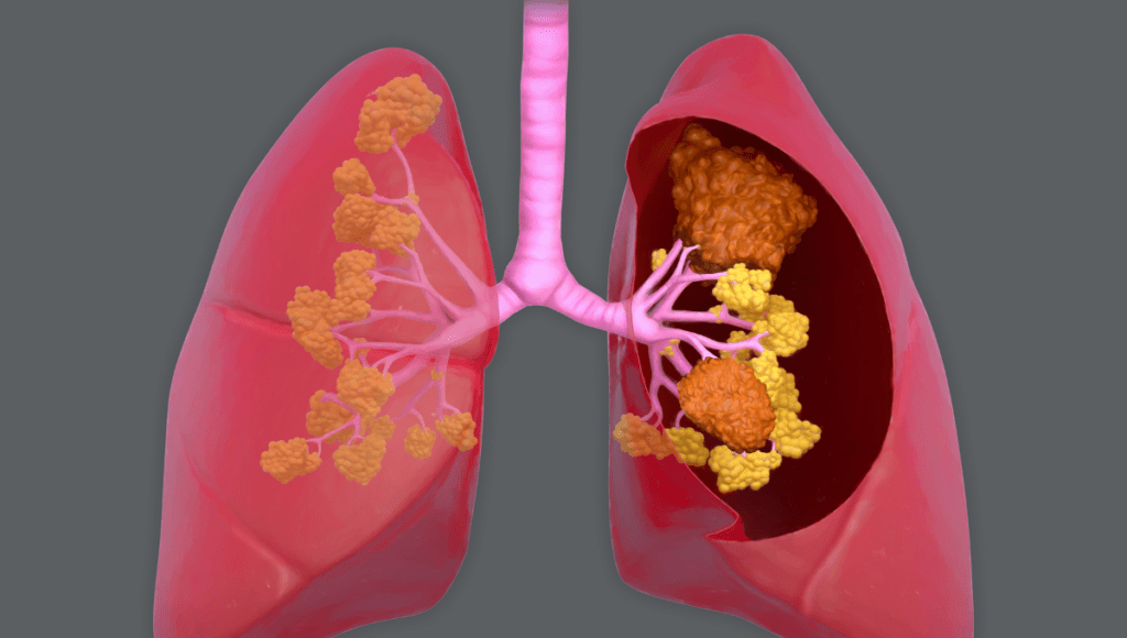 Eine Lunge mit Lungenkrebs
